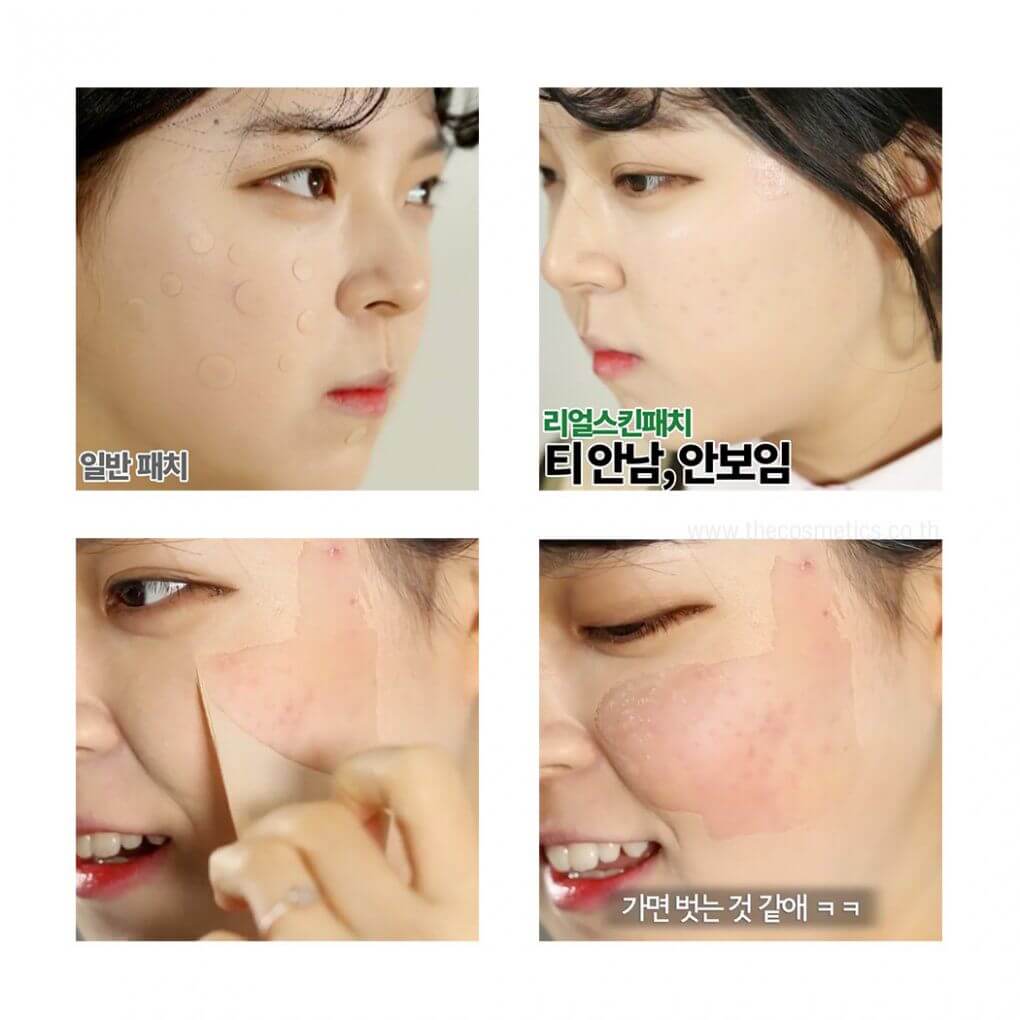 Not4U Real Skin Patch,เจลปิดสิว,เจลใสซิลิโคนปกปิดสิว